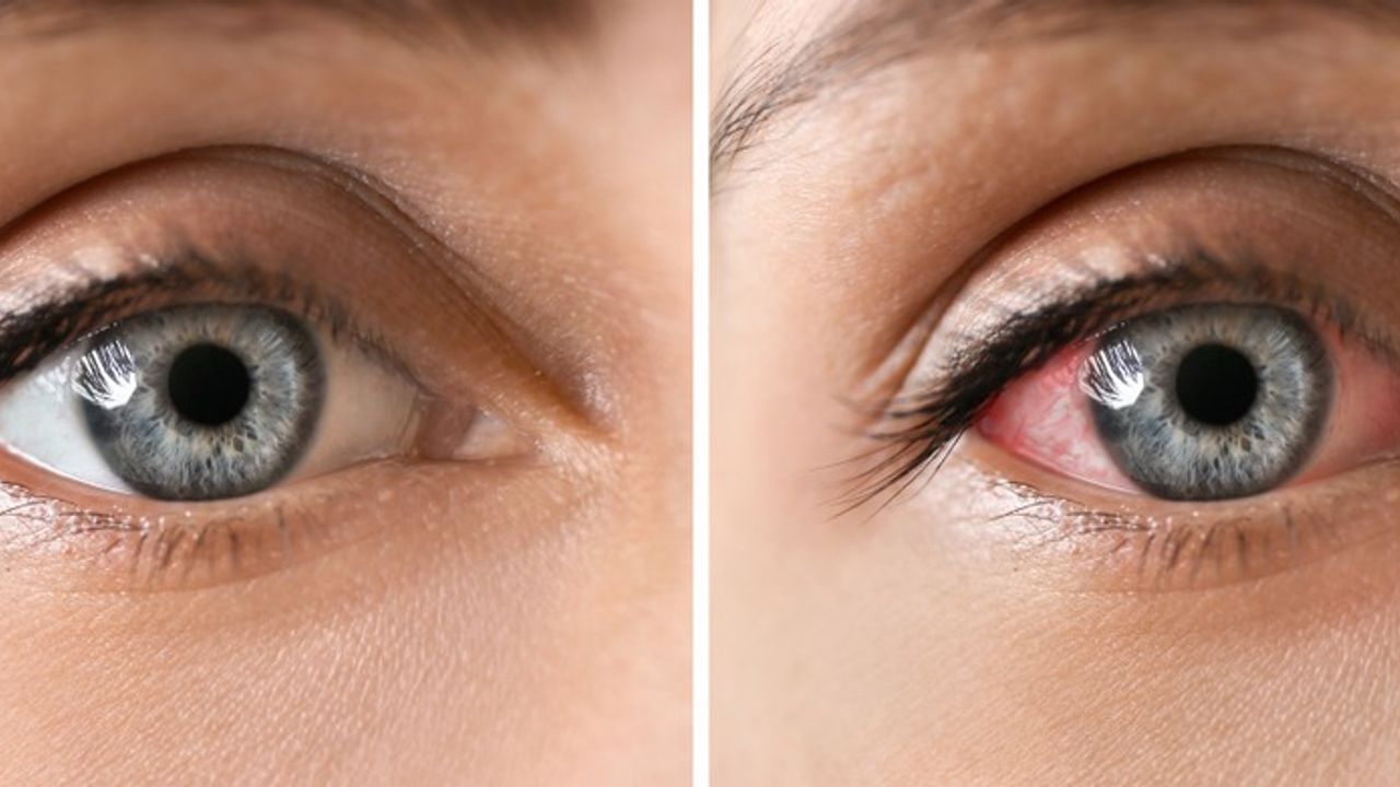 Göz Enfeksiyonu Nedir? Belirtileri Nelerdir?