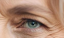 Göz kapağı sarkmalarına cerrahi çözüm