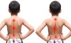 “Skolyoz, Çocukların Geleceğine Engel Değil”