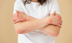 Ürtiker Nedir, Nasıl Tedavi Edilir?