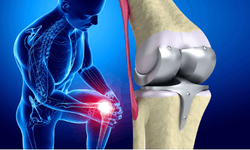 Diz ağrılarını göz ardı etmeyin!