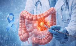 Kolon kanserinde erken teşhisin önemi