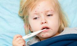 Su Çiçeği Hastalığı Nedir?