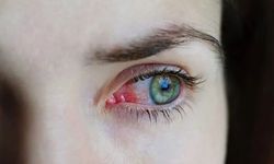 Bahar aylarında göz alerjilerine dikkat!
