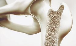 Uzmanından osteoporoz uyarısı