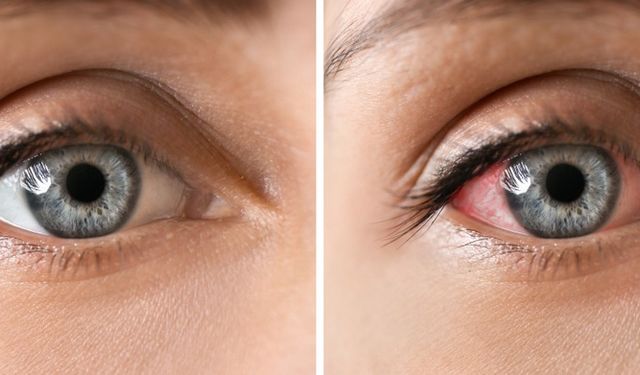 Göz Enfeksiyonu Nedir? Belirtileri Nelerdir?
