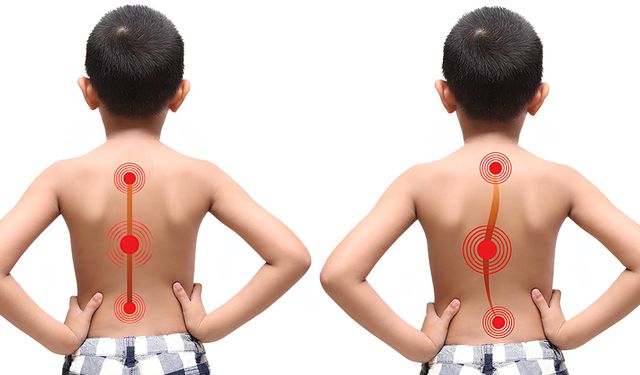 “Skolyoz, Çocukların Geleceğine Engel Değil”