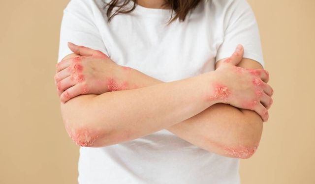 Ürtiker Nedir, Nasıl Tedavi Edilir?