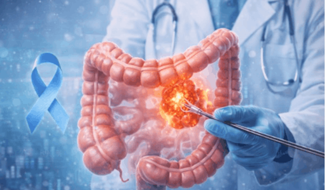 Kolon kanserinde erken teşhisin önemi