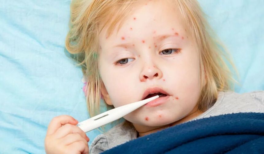 Su Çiçeği Hastalığı Nedir?