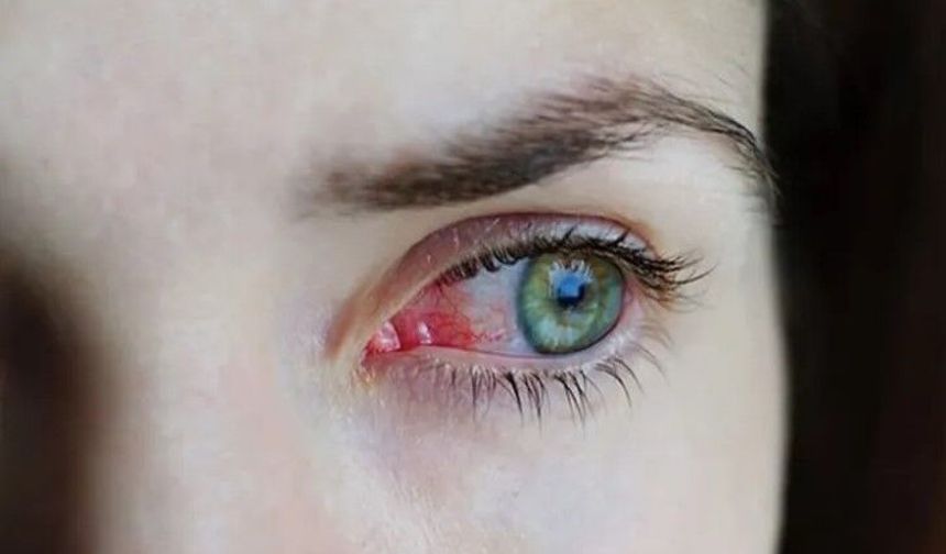 Bahar aylarında göz alerjilerine dikkat!